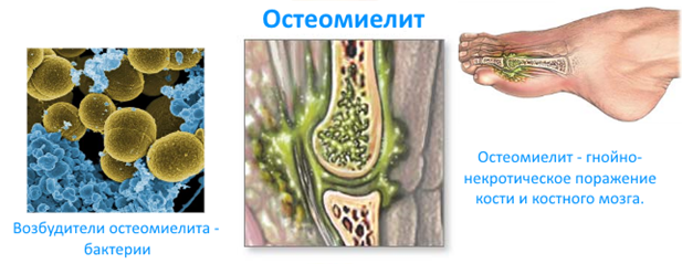 Остеомиелит (воспаление) - что это: как проявляется, причины развития, виды заболевания, диагностика и лечение