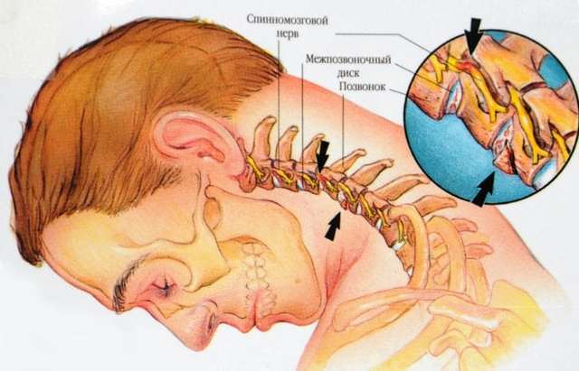 Плечевой остеохондроз: причины появления и развития, симптомы, лечение и профилактика болезни, рекомендации врачей