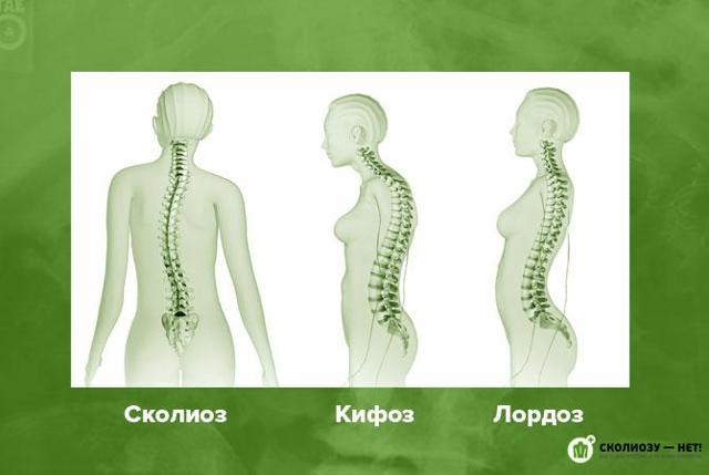 Сколиоз позвоночника, спины - что это такое: симптомы у взрослых, стадии, осложнения, упражнения и гимнастика, лечение и профилактика