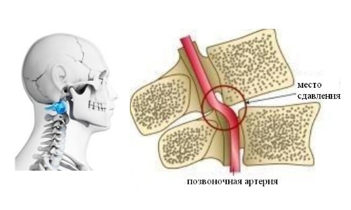 Тремор головы: причины, физиотерапевтическое и медикаментозное лечение при шейном остеохондрозе, профилактика и рекомендации
