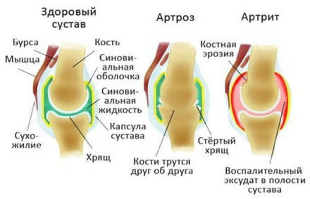 Виды остеохондроза: - шейный, поясничный, грудной и плечевой, клиническая картина, особенности диагностики, лечение и профилактика