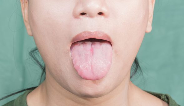 Жжение языка и онемение лица и языка при шейном остеохондрозе: основные причины, способы купирования симптома и правила лечения