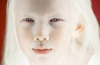 Альбинос: кто такой, 3 типа альбинизма, способы лечения и советы