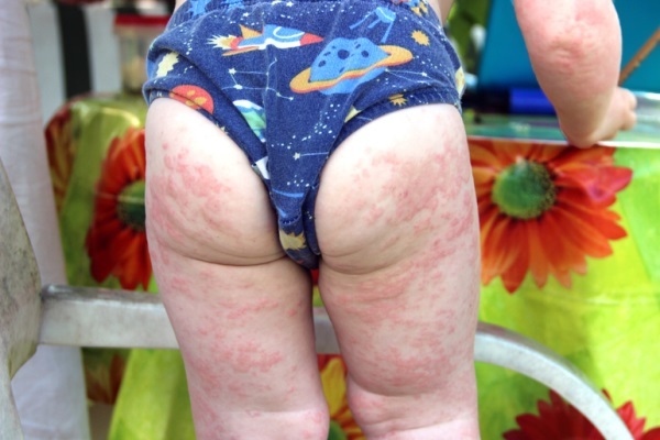 Аллергия на порошок у ребенка: как проявляется, 6 факторов риска и 4 основных аллергена