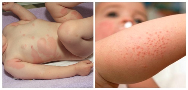 Аллергия у новорожденных и у детей постарше: причины, группы и виды, лечение и профилактика болезни