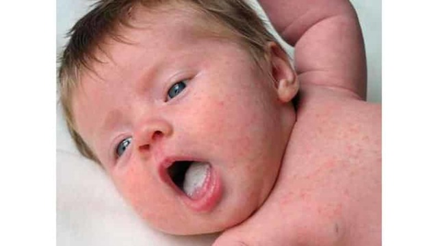Белый налет на языке у ребенка: 3 основных причины и 3 способа очистить язык грудничку