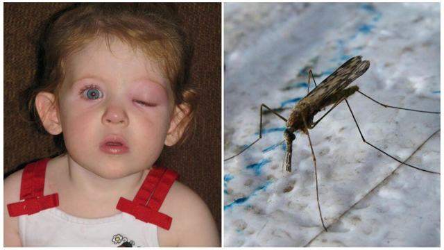 Чем для детских глаз опасны укусы комаров: глазной дирофилляриоз, лечение и профилактика