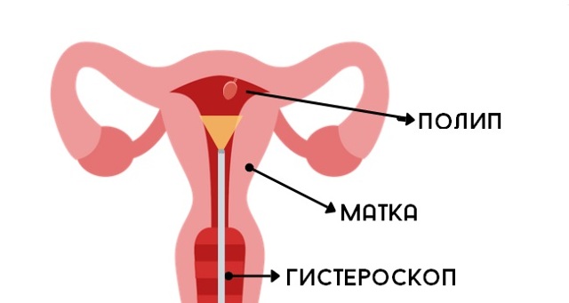Что такое аденоматозный полип эндометрия и какое лечение нужно женщине после его удаления