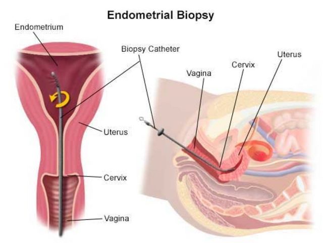 Что такое биопсия эндометрия и какие виды бывают