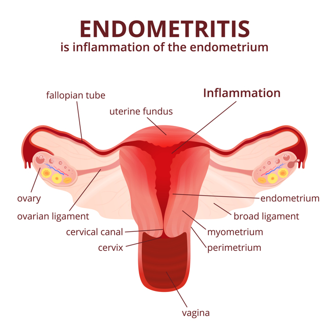 Что такое эндометрит, как проявляется болезнь и как ее лечить