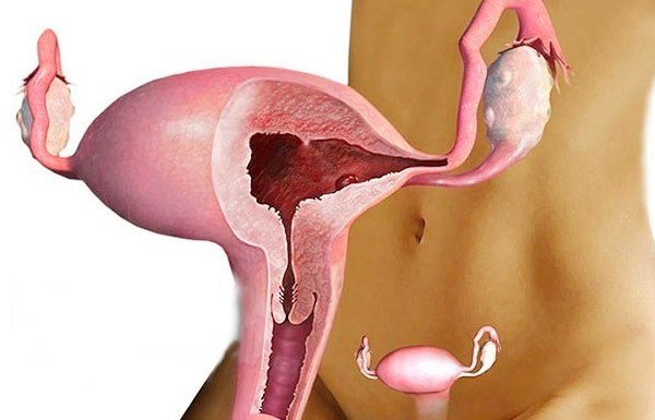 Формы железистой гиперплазии эндометрия и особенности лечения
