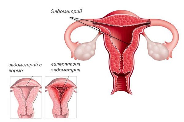 Формы железистой гиперплазии эндометрия и особенности лечения