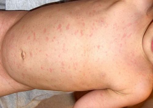 Герпес 6 типа у детей: симптомы и лечение заболевания, мнение доктора комаровского