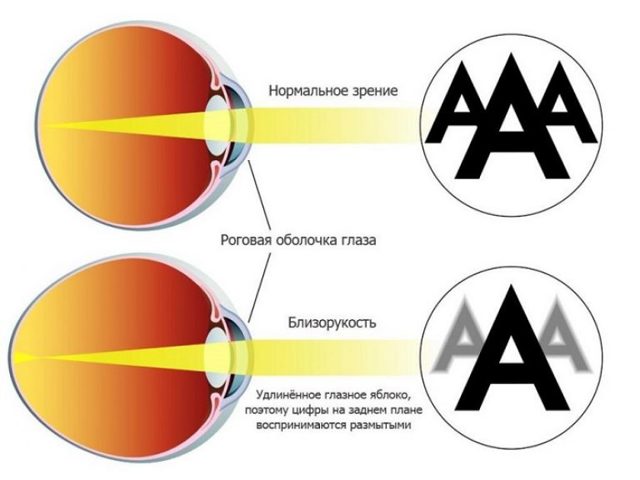 Глазные капли для улучшения зрения при близорукости и другие методы лечения