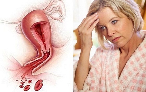Как проходит менструация при эндометриозе