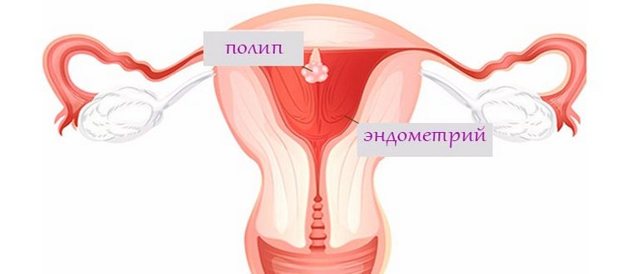 Как проводится выскабливание матки при эндометриозе