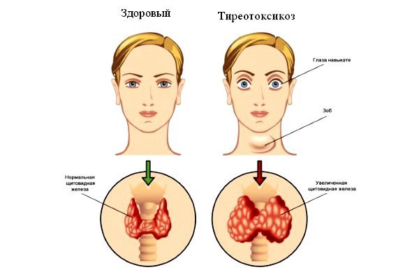 Как вовремя обнаружить гипотиреоз в период менопаузы