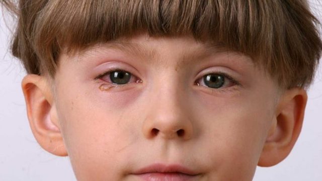 Конъюнктивит у детей: 4 разновидности одной болезни и советы педиатра