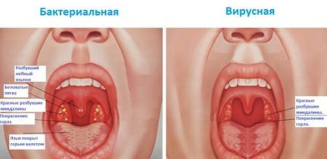 Лечение ангины у детей в домашних условиях: 5 правил полоскания горла