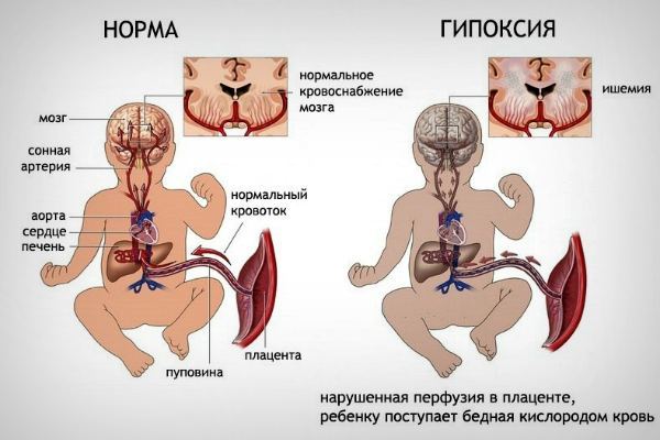 Нейросонография головного мозга новорожденных: 6 поводов для назначения, расшифровка результатов