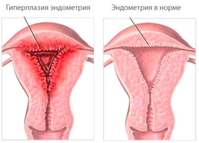 Особенности лечения дюфастоном и норколутом при гиперплазии эндометрия