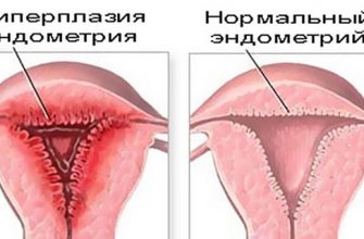 Особенности лечения гиперплазии эндометрия после выскабливания
