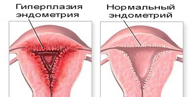 Особенности лечения гиперплазии эндометрия после выскабливания