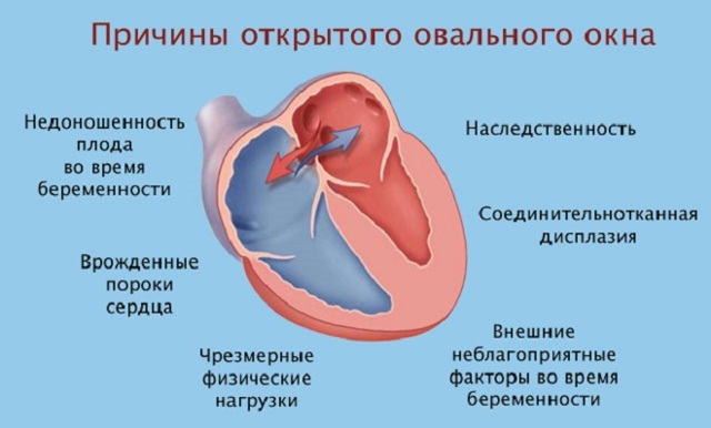 Открытое овальное окно в сердце у ребенка: 9 причин и 5 симптомов, чем опасно, лечение и последствия