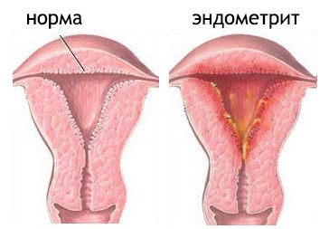 Отличия между эндометритом и эндометриозом