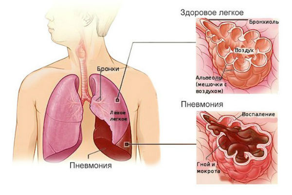 Пневмония у детей: симптомы и осложнения бронхита, лечение, профилактика