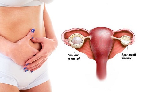 Почему появляются коричневые выделения после менструации