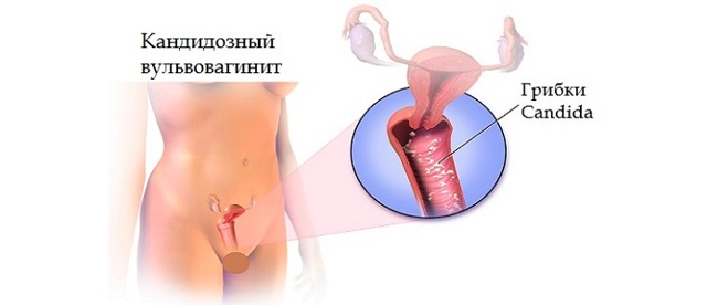 Почему появляются коричневые выделения после менструации