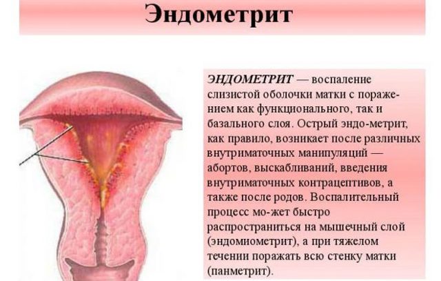 Препараты для лечения эндометрита у женщин