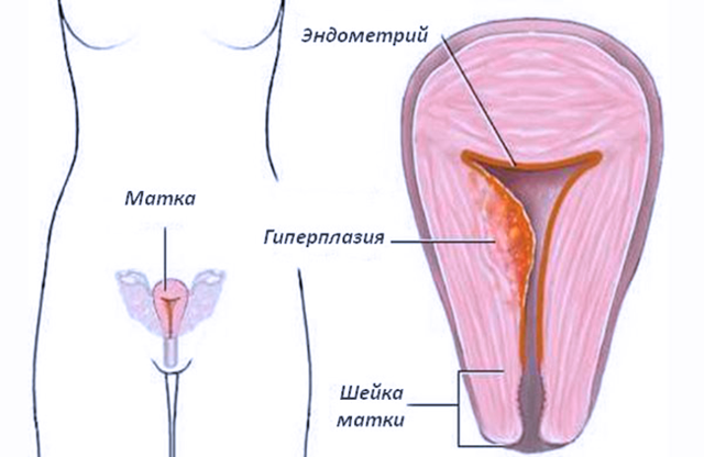 Причины и лечение гиперплазии эндометрия в менопаузе
