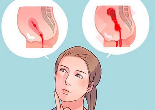 Причины появления кровотечений между менструациями