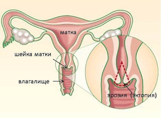 Причины развития и лечение эктопии шейки матки