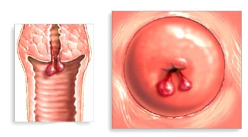 Причины возникновения и методы лечения полипа цервикального канала при беременности