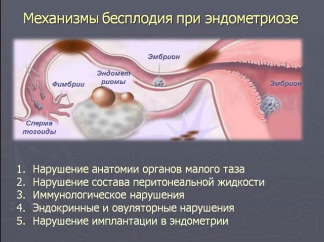 Признаки эндометриоза на УЗИ