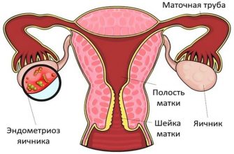 Симптоматика и методы лечения эндометриоза яичника