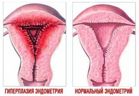 Симптомы и лечение очаговой гиперплазии эндометрия
