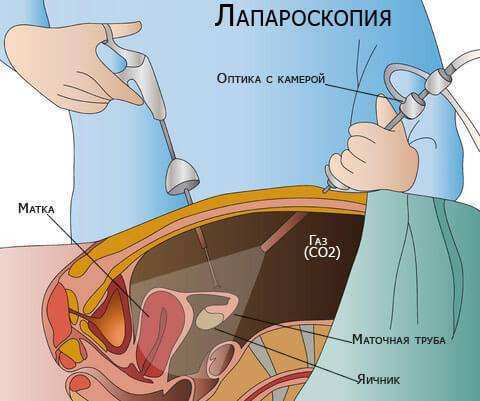 Симптомы и лечение параовариальной кисты яичника