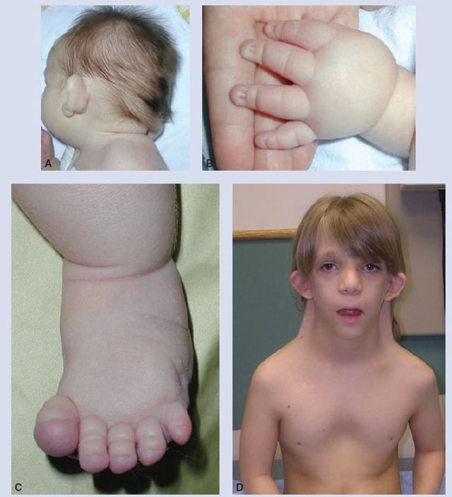 Синдром шерешевского тёрнера : 13 признаков генетического синдрома