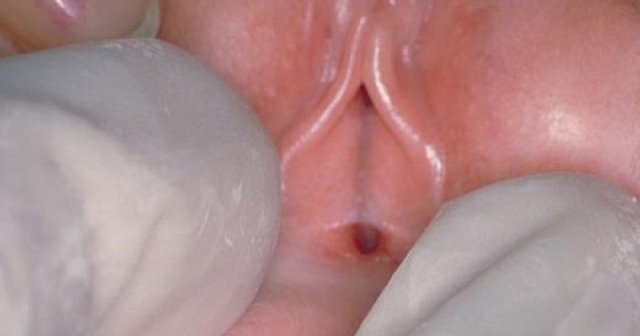Сращение малых половых губ у девочек: причины, симптомы, лечение, профилактика
