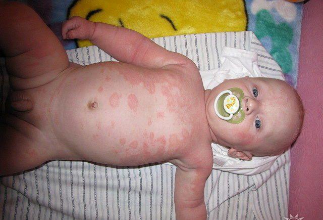 Температура после акдс у ребёнка: причины повышения, безопасные препараты, 8 возможных реакций на прививку