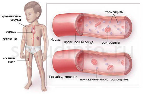 Тромбоцитопатия у детей: 8 причин, 3 общих симптома, методы лечения