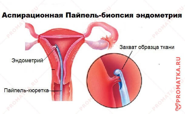 Возможность беременности при гиперплазии эндометрия