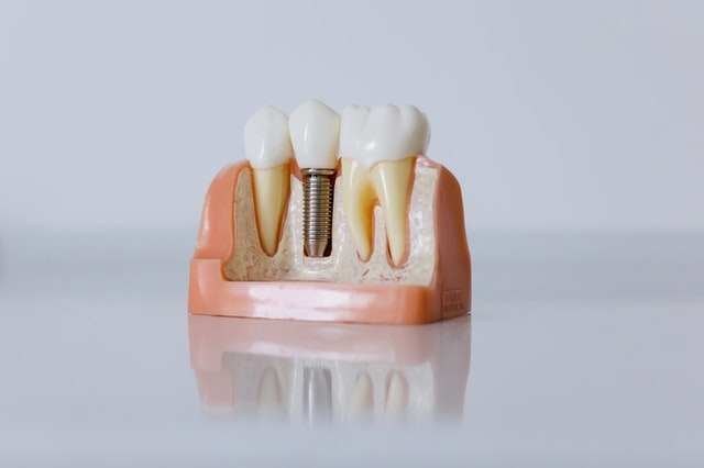 Чем привлекательна операция по имплантации зуба для пациентов?