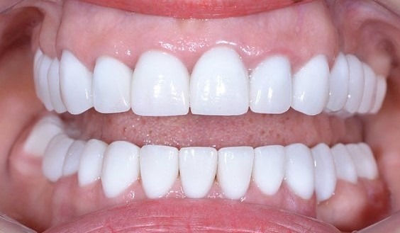 Применение виниров в эстетической стоматологии, разновидности виниров